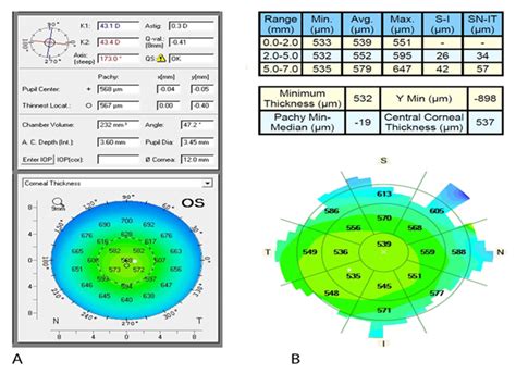 normal corneal thickness measurements|corneal thickness iop conversion chart.